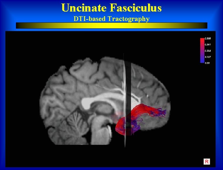 Uncinate Fasciculus DTI-based Tractography 