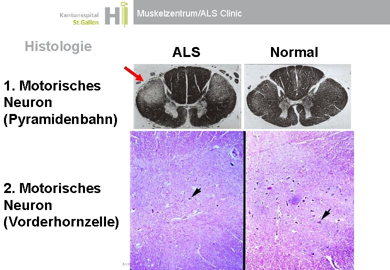 Muskelzentrum/ALS Clinic Histologie 1. Motorisches Neuron (Pyramidenbahn) 2. Motorisches Neuron (Vorderhornzelle) ALS Normal Muskelzentrum/ALS Clinic Histologie 1. Motorisches Neuron (Pyramidenbahn) 2. Motorisches Neuron (Vorderhornzelle) ALS Normal