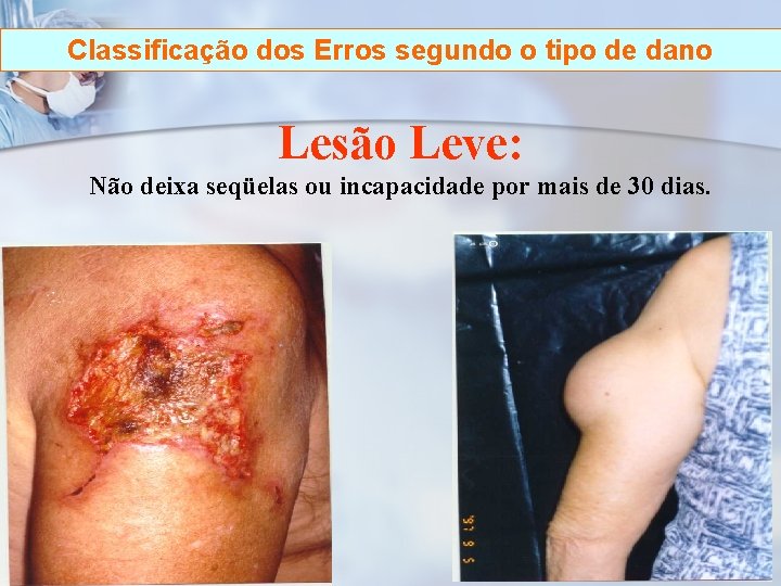 Classificação dos Erros segundo o tipo de dano Lesão Leve: Não deixa seqüelas ou