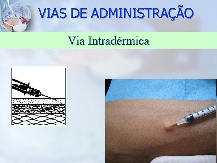 VIAS DE ADMINISTRAÇÃO Via Intradérmica 