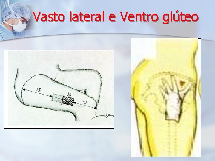 Vasto lateral e Ventro glúteo 