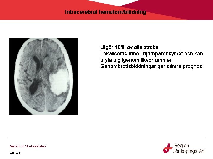 Intracerebral hematom/blödning Utgör 10% av alla stroke Lokaliserad inne i hjärnparenkymet och kan bryta Intracerebral hematom/blödning Utgör 10% av alla stroke Lokaliserad inne i hjärnparenkymet och kan bryta