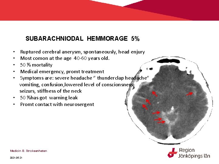 SUBARACHNIODAL HEMMORAGE 5% Ruptured cerebral anerysm, spontaneously, head enjury Most comon at the age SUBARACHNIODAL HEMMORAGE 5% Ruptured cerebral anerysm, spontaneously, head enjury Most comon at the age