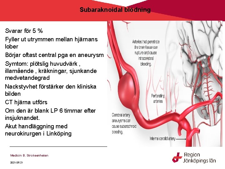 Subaraknoidal blödning Svarar för 5 % Fyller ut utrymmen mellan hjärnans lober Börjar oftast Subaraknoidal blödning Svarar för 5 % Fyller ut utrymmen mellan hjärnans lober Börjar oftast