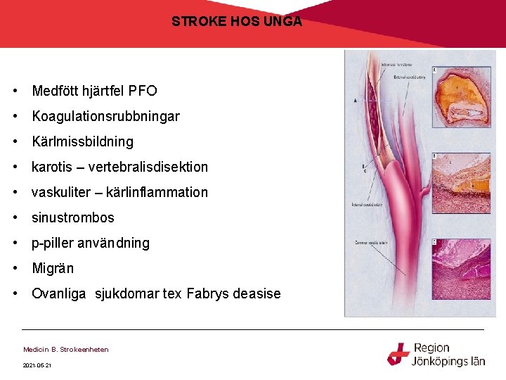 STROKE HOS UNGA • Medfött hjärtfel PFO • Koagulationsrubbningar • Kärlmissbildning • karotis – STROKE HOS UNGA • Medfött hjärtfel PFO • Koagulationsrubbningar • Kärlmissbildning • karotis –
