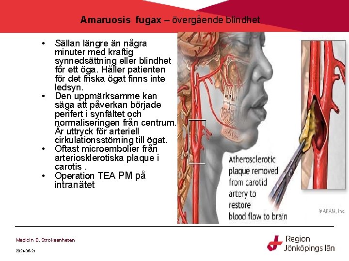 Amaruosis fugax – övergående blindhet • • Sällan längre än några minuter med kraftig Amaruosis fugax – övergående blindhet • • Sällan längre än några minuter med kraftig