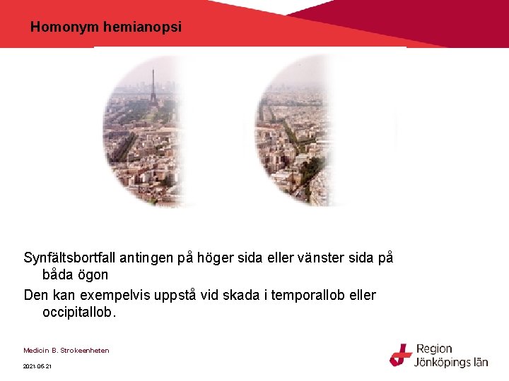Homonym hemianopsi Synfältsbortfall antingen på höger sida eller vänster sida på båda ögon Den Homonym hemianopsi Synfältsbortfall antingen på höger sida eller vänster sida på båda ögon Den