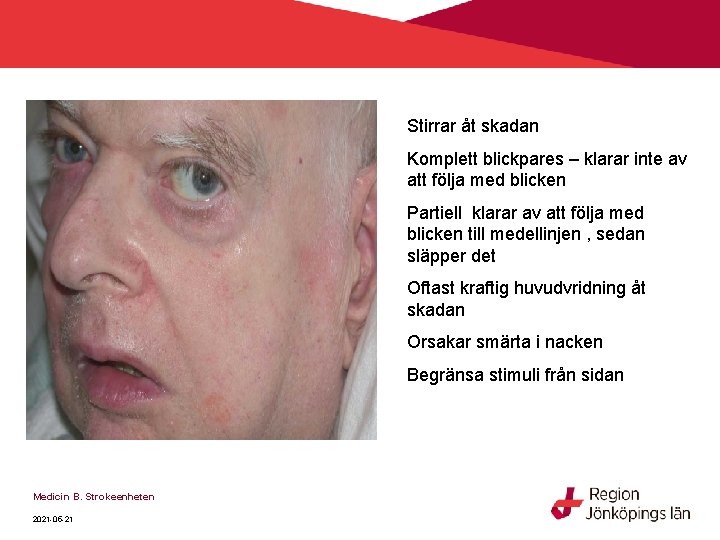 Stirrar åt skadan Komplett blickpares – klarar inte av att följa med blicken Partiell Stirrar åt skadan Komplett blickpares – klarar inte av att följa med blicken Partiell