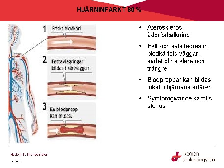 HJÄRNINFARKT 80 % • Ateroskleros – åderförkalkning • Fett och kalk lagras in blodkärlets HJÄRNINFARKT 80 % • Ateroskleros – åderförkalkning • Fett och kalk lagras in blodkärlets