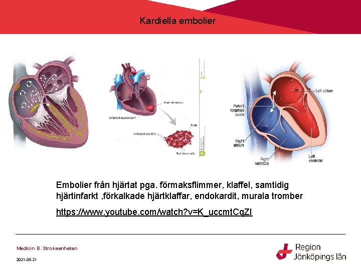 Kardiella embolier Embolier från hjärtat pga. förmaksflimmer, klaffel, samtidig hjärtinfarkt , förkalkade hjärtklaffar, endokardit, Kardiella embolier Embolier från hjärtat pga. förmaksflimmer, klaffel, samtidig hjärtinfarkt , förkalkade hjärtklaffar, endokardit,