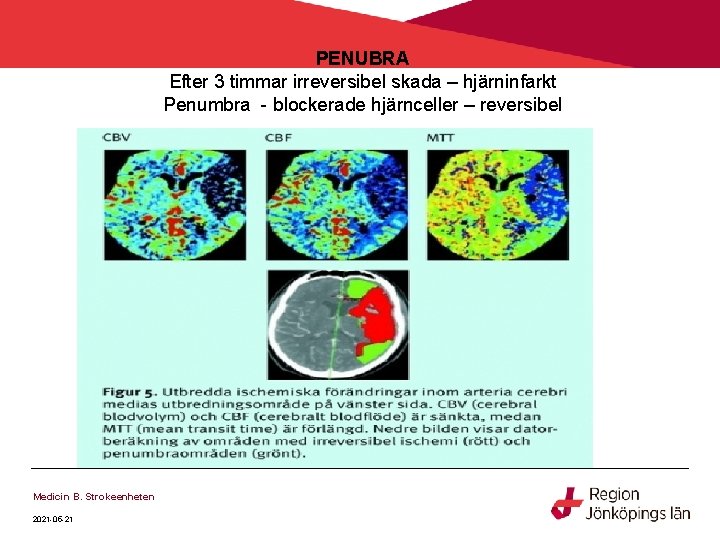 PENUBRA Efter 3 timmar irreversibel skada – hjärninfarkt Penumbra - blockerade hjärnceller – reversibel PENUBRA Efter 3 timmar irreversibel skada – hjärninfarkt Penumbra - blockerade hjärnceller – reversibel