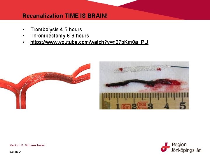 Recanalization TIME IS BRAIN! • • • Trombolysis 4, 5 hours Thrombectomy 6 -9 Recanalization TIME IS BRAIN! • • • Trombolysis 4, 5 hours Thrombectomy 6 -9