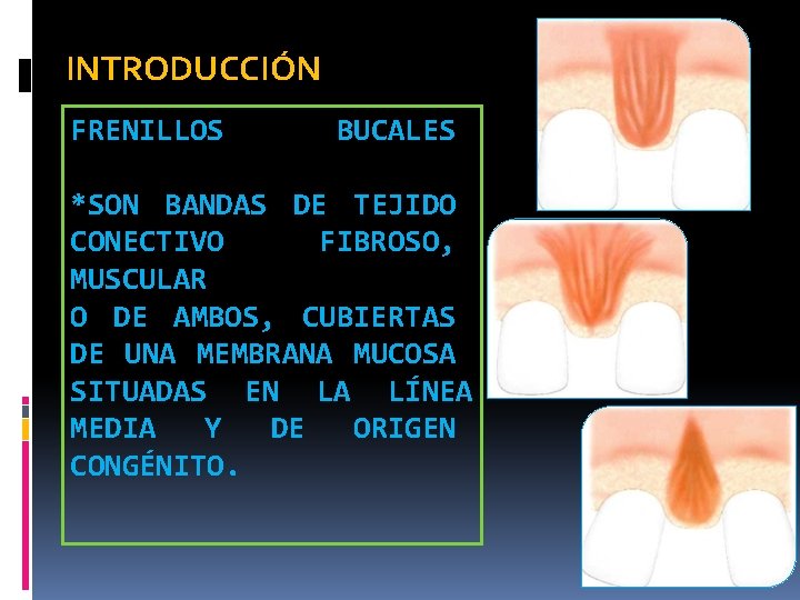 INTRODUCCIÓN FRENILLOS BUCALES *SON BANDAS DE TEJIDO CONECTIVO FIBROSO, MUSCULAR O DE AMBOS, CUBIERTAS