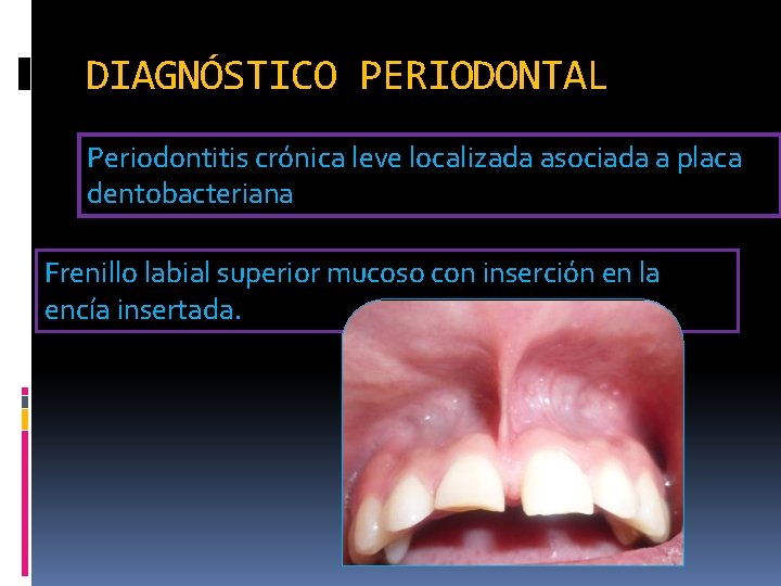 DIAGNÓSTICO PERIODONTAL Periodontitis crónica leve localizada asociada a placa dentobacteriana Frenillo labial superior mucoso