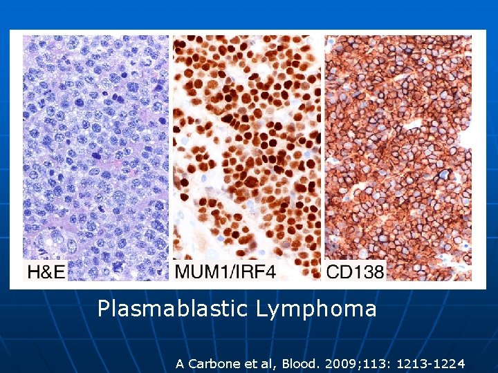 Plasmablastic Lymphoma A Carbone et al, Blood. 2009; 113: 1213 -1224 