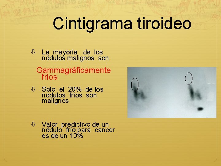Cintigrama tiroideo La mayoría de los nódulos malignos son Gammagráficamente fríos Solo el 20%
