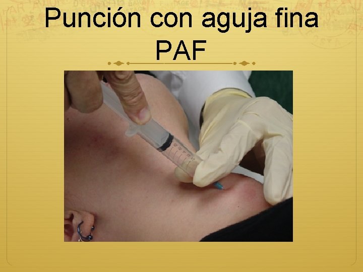 Punción con aguja fina PAF 