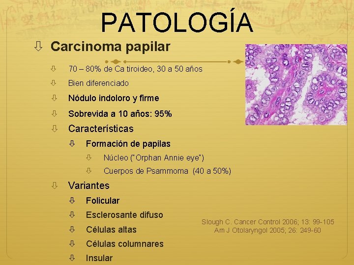 PATOLOGÍA Carcinoma papilar 70 – 80% de Ca tiroideo, 30 a 50 años Bien