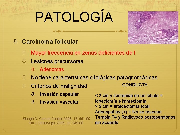 PATOLOGÍA Carcinoma folicular Mayor frecuencia en zonas deficientes de I Lesiones precursoras Adenomas No