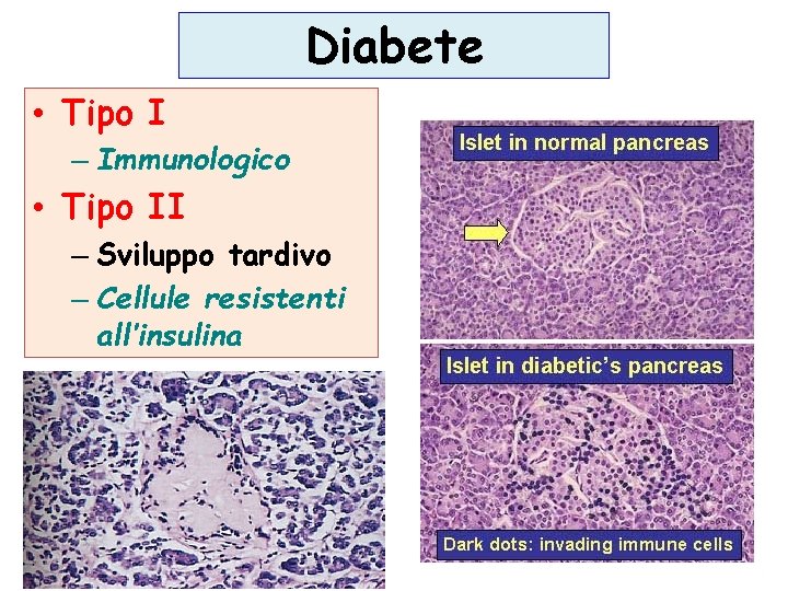 Diabete • Tipo I – Immunologico • Tipo II – Sviluppo tardivo – Cellule