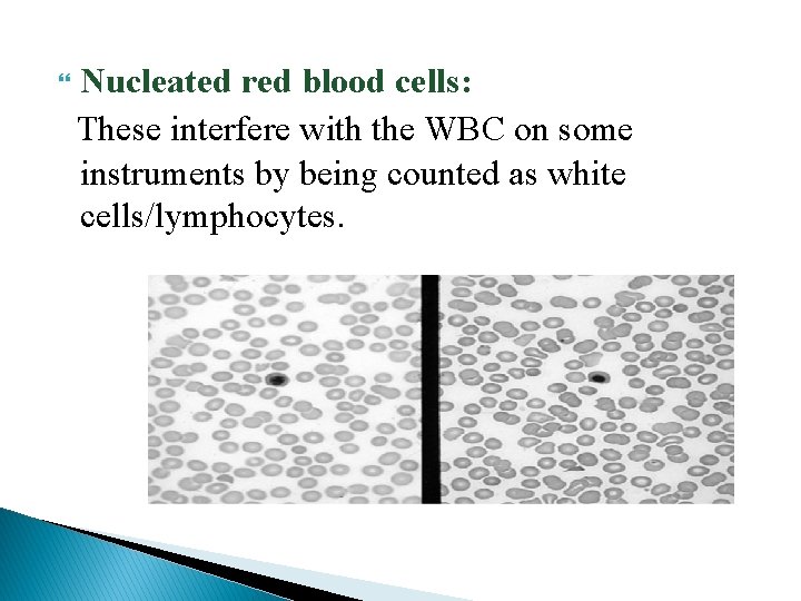  Nucleated red blood cells: These interfere with the WBC on some instruments by