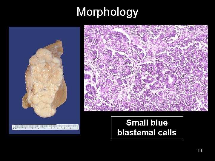 Morphology Small blue blastemal cells 14 
