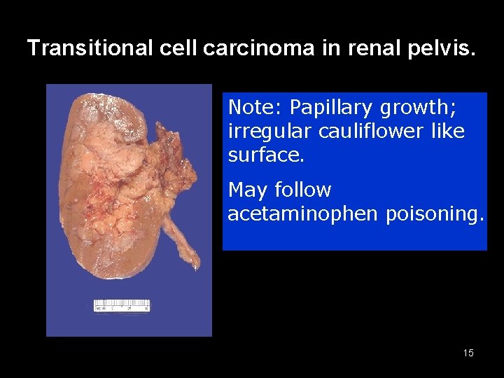 Transitional cell carcinoma in renal pelvis. Note: Papillary growth; irregular cauliflower like surface. May