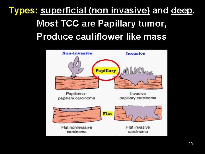 Types: superficial (non invasive) and deep. Most TCC are Papillary tumor, Produce cauliflower like