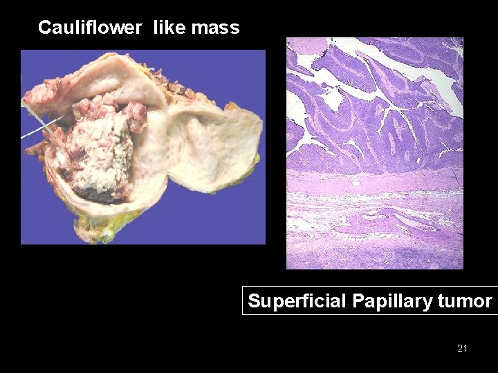 Cauliflower like mass Superficial Papillary tumor 21 
