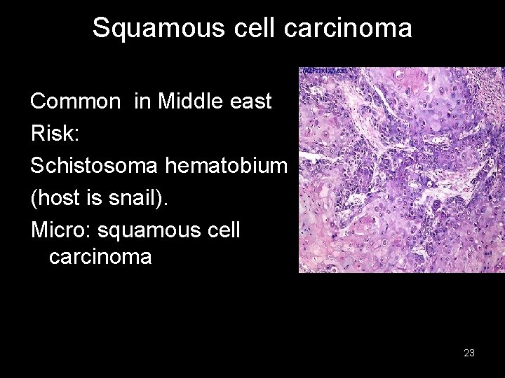 Squamous cell carcinoma Common in Middle east Risk: Schistosoma hematobium (host is snail). Micro: