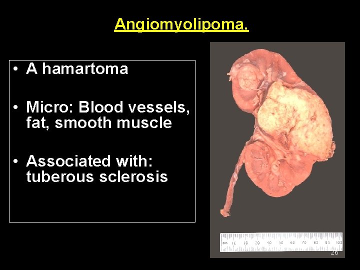 Angiomyolipoma. • A hamartoma • Micro: Blood vessels, fat, smooth muscle • Associated with: