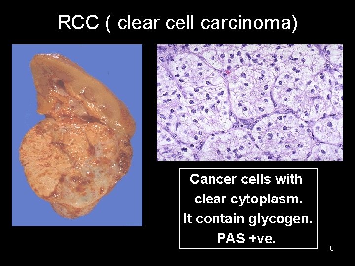 RCC ( clear cell carcinoma) Cancer cells with clear cytoplasm. It contain glycogen. PAS