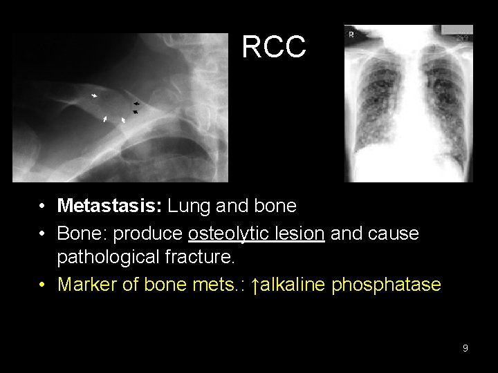 RCC • Metastasis: Lung and bone • Bone: produce osteolytic lesion and cause pathological