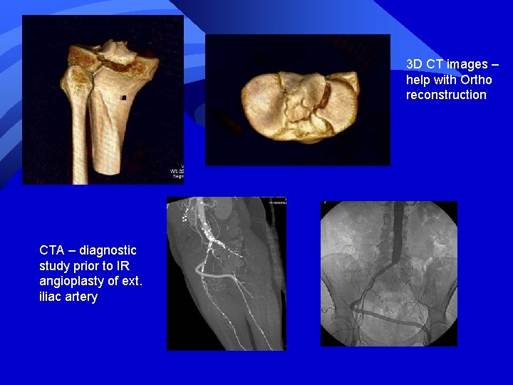 3 D CT images – help with Ortho reconstruction CTA – diagnostic study prior