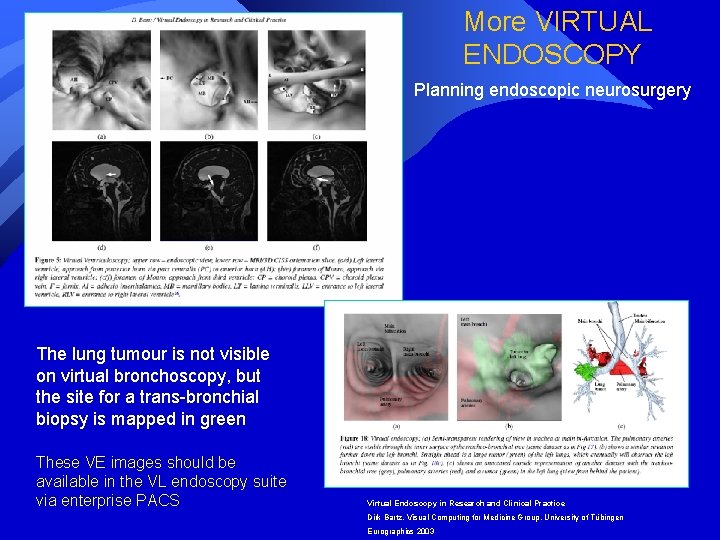 More VIRTUAL ENDOSCOPY Planning endoscopic neurosurgery The lung tumour is not visible on virtual