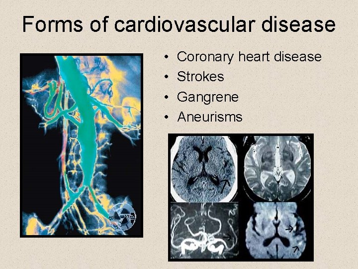 Forms of cardiovascular disease • • Coronary heart disease Strokes Gangrene Aneurisms 