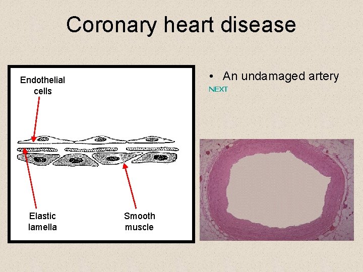 Coronary heart disease • An undamaged artery Endothelial cells Elastic lamella NEXT Smooth muscle