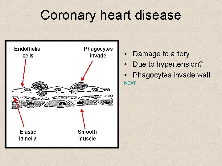 Coronary heart disease Endothelial cells Phagocytes invade • Damage to artery • Due to