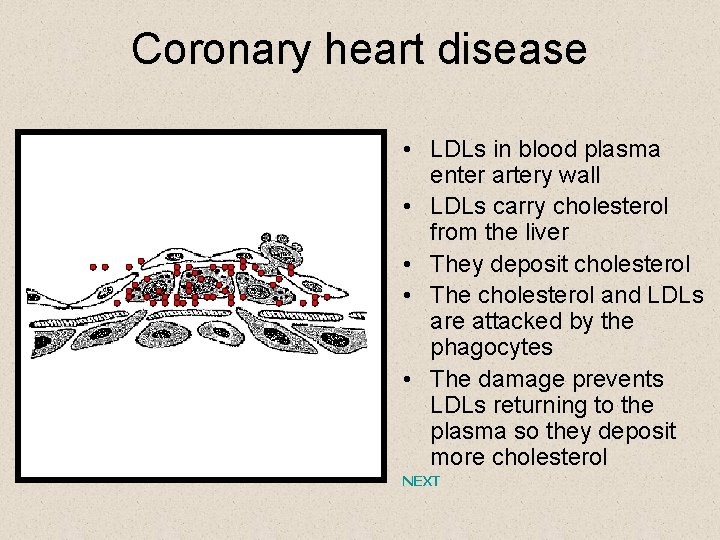 Coronary heart disease • LDLs in blood plasma enter artery wall • LDLs carry