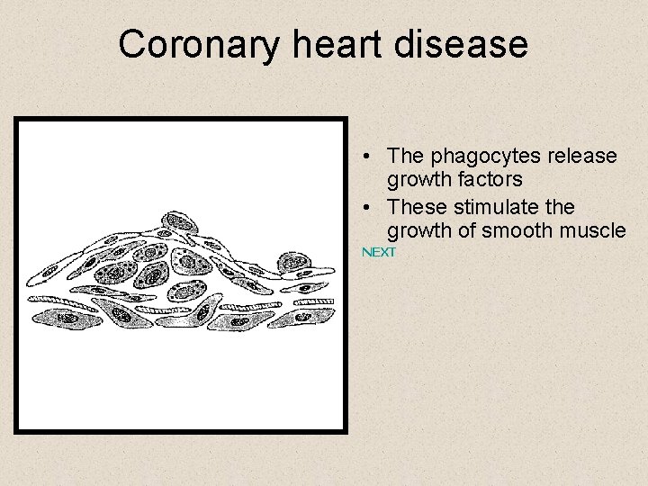 Coronary heart disease • The phagocytes release growth factors • These stimulate the growth