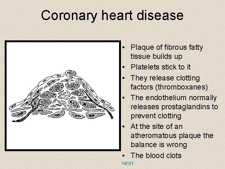 Coronary heart disease • Plaque of fibrous fatty tissue builds up • Platelets stick