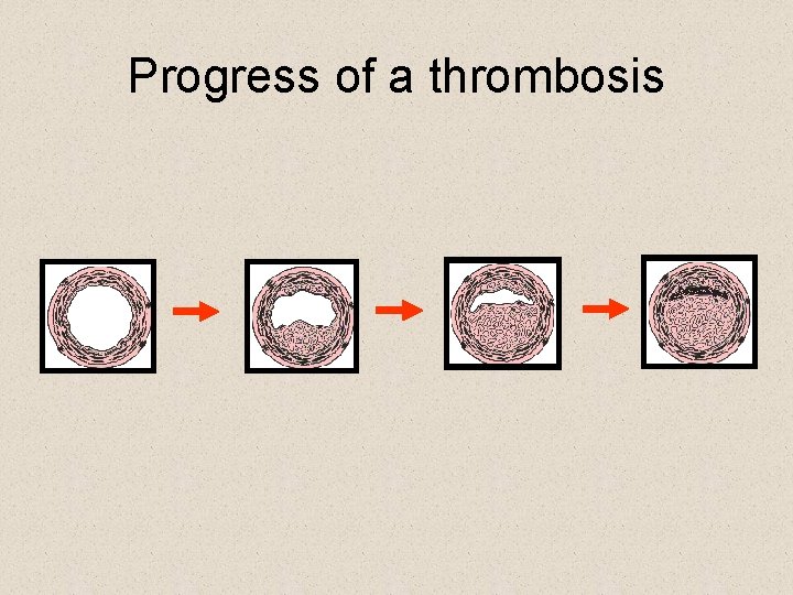 Progress of a thrombosis 