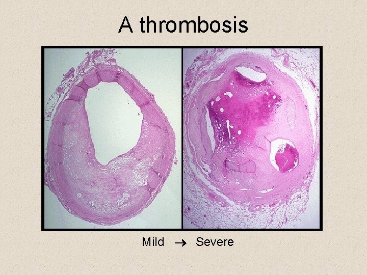 A thrombosis Mild ® Severe 