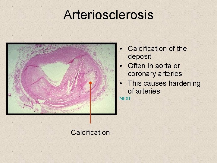 Arteriosclerosis • Calcification of the deposit • Often in aorta or coronary arteries •