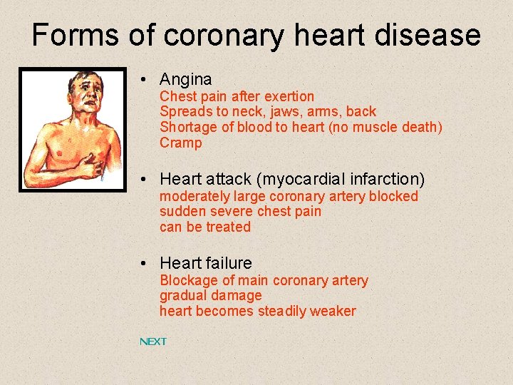 Forms of coronary heart disease • Angina Chest pain after exertion Spreads to neck,