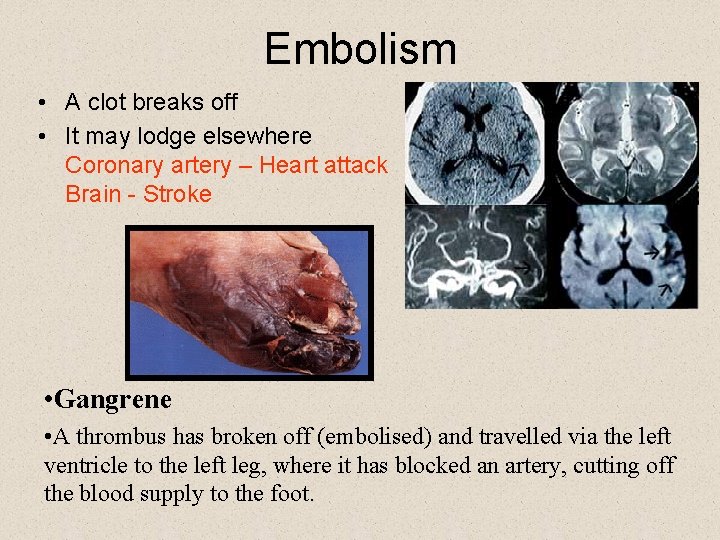 Embolism • A clot breaks off • It may lodge elsewhere Coronary artery –