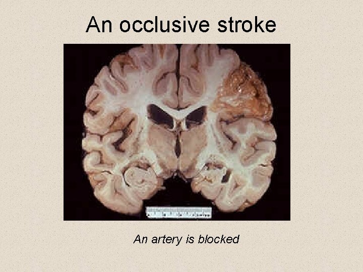 An occlusive stroke An artery is blocked 