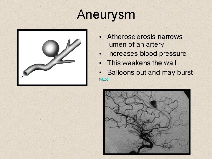 Aneurysm • Atherosclerosis narrows lumen of an artery • Increases blood pressure • This