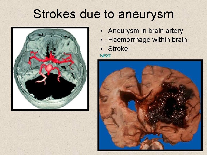 Strokes due to aneurysm • Aneurysm in brain artery • Haemorrhage within brain •