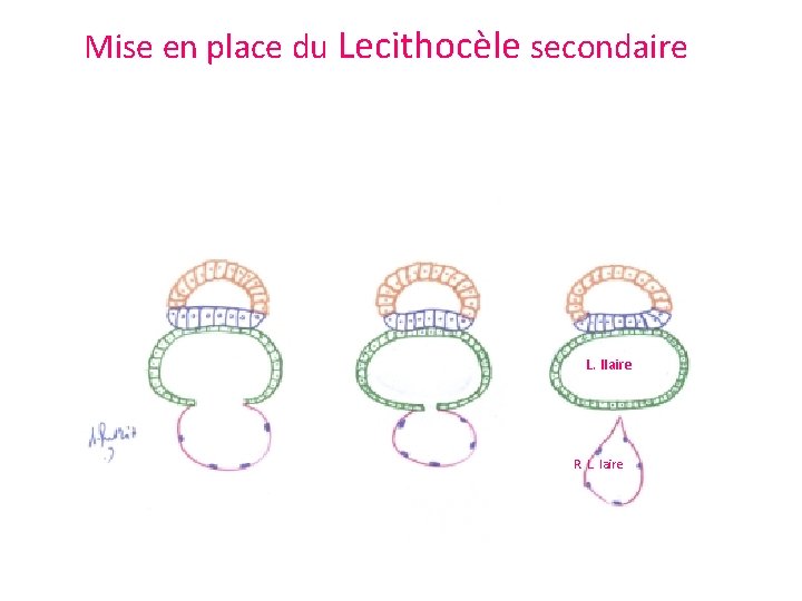 Mise en place du Lecithocèle secondaire L. IIaire R. L. Iaire 